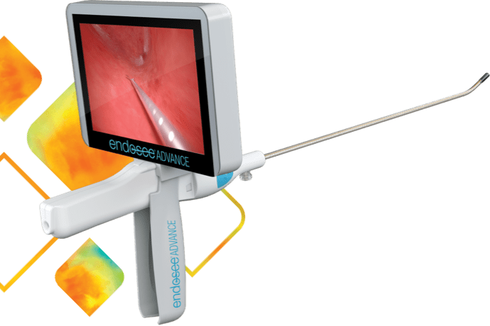 Diagnostic Office Hysteroscopy Device - Endosee